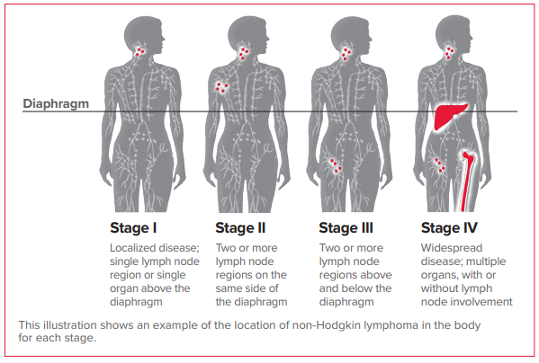 Https://www.lls.org/lymphoma/non-hodgkin-lymphoma/diagnosis/nhl-staging